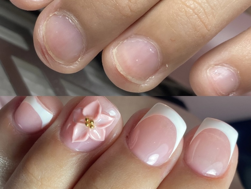 Tratamiento Onicofagia x3