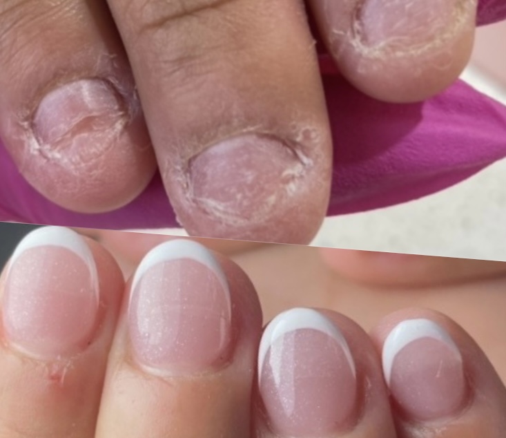 Tratamiento Onicofagia